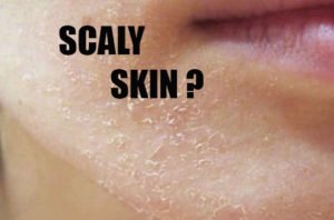 SIGNS-AND-SYMPTOMS-OF-SCALY-SKIN